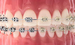 self-ligating braces